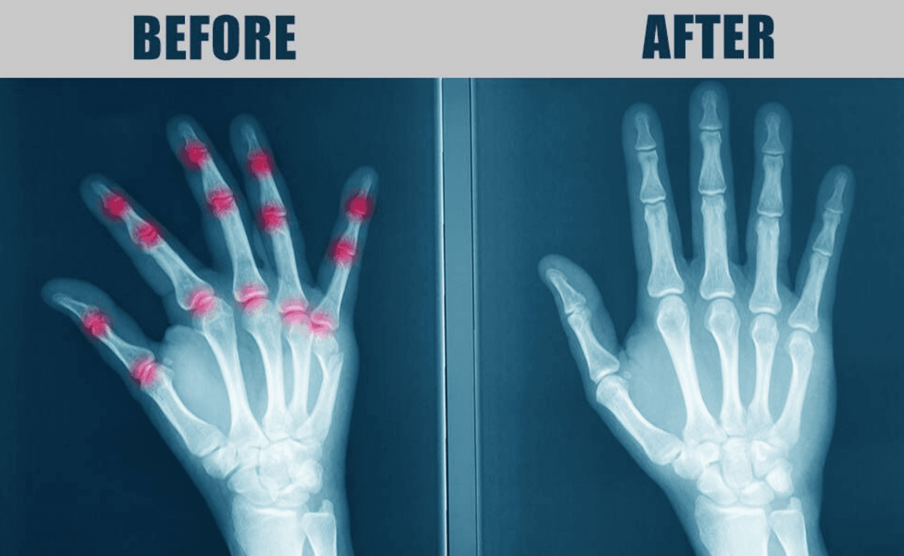 Alevez HandBliss Massager-FDA-approved natural healing for hands, wrists & fingers